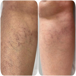 varices avant après