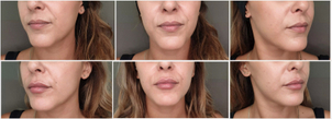 Avant / après augmentation des lèvres