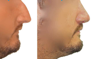 avant / après génioplastie