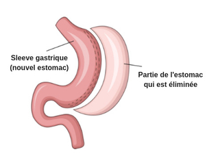 La sleeve gastrectomie une solution radicale contre l'obésité