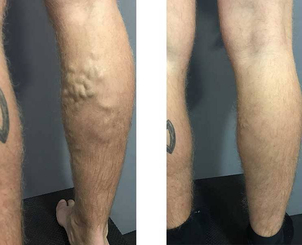 varices avant après