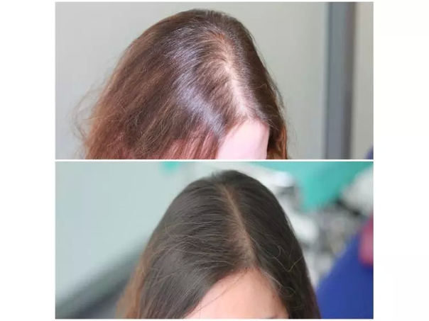 greffe de cheveux avant / après