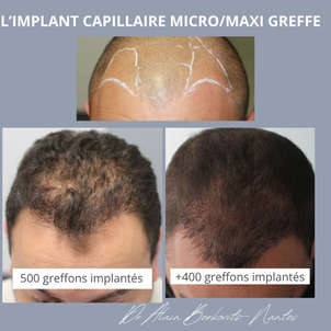 greffe de cheveux avant / après