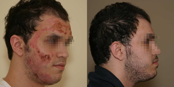reconstruction de la face après une brûlure