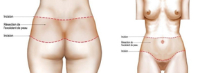 le bodylift