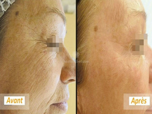 Photorajeunissement avant/après