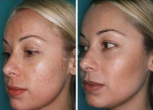 peeling avant / après