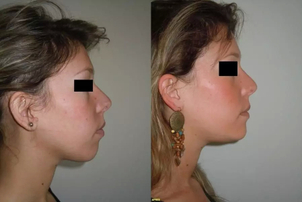 avant / après chirurgie maxillo-faciale