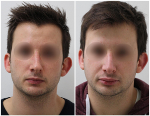 avant / après rhinoplastie