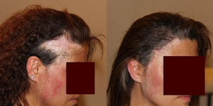 calvitie femme avant / après