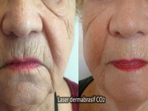 avant / après laser dermatologique