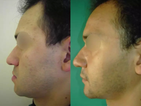 avant / après chirurgie maxillo-faciale