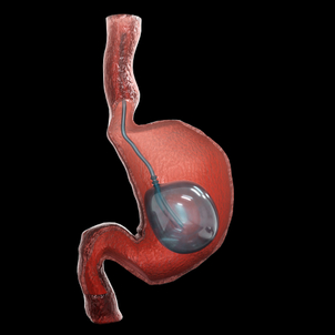 Ballon gastrique Orbera