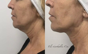 fils tenseurs avant / après