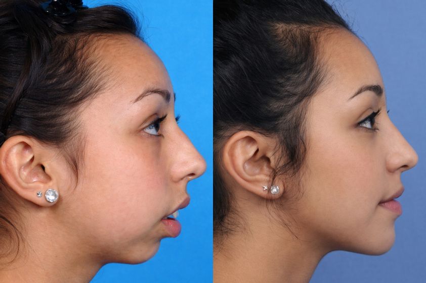 Génioplastie