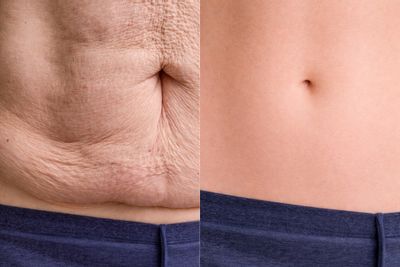 Avant/après de Abdominoplastie
