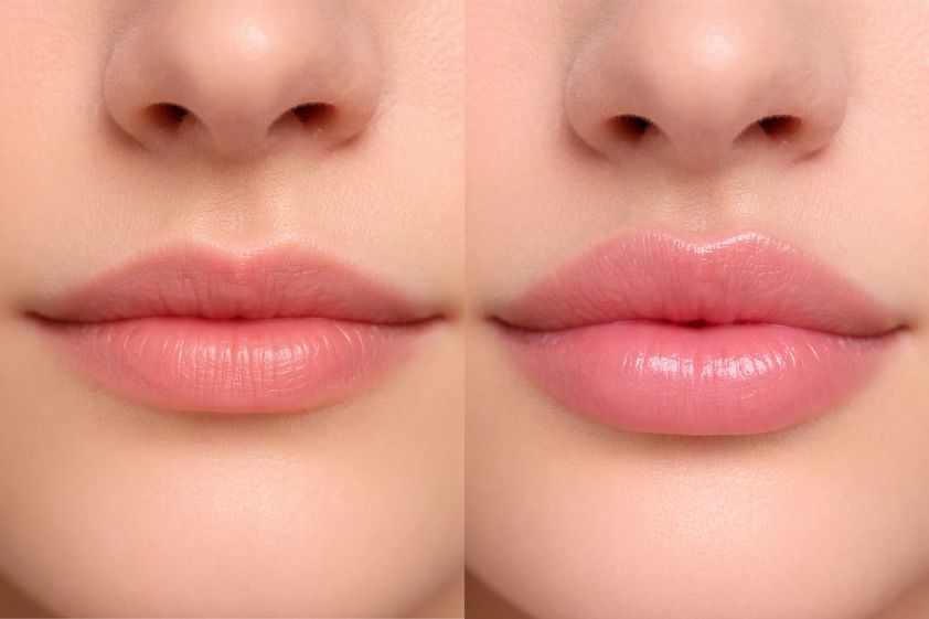 Augmentation des lèvres