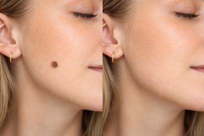 Avant/après de Grains de beauté