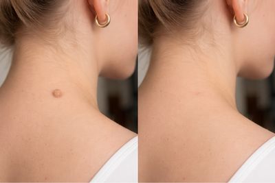 Avant/après de Verrues