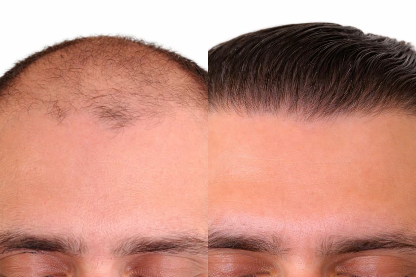 Greffe de cheveux