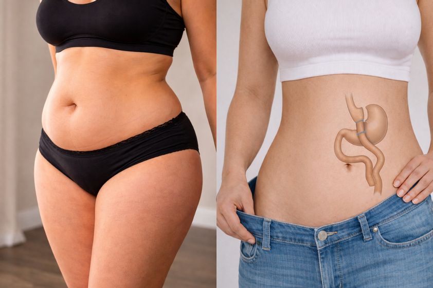 Bypass gastrique