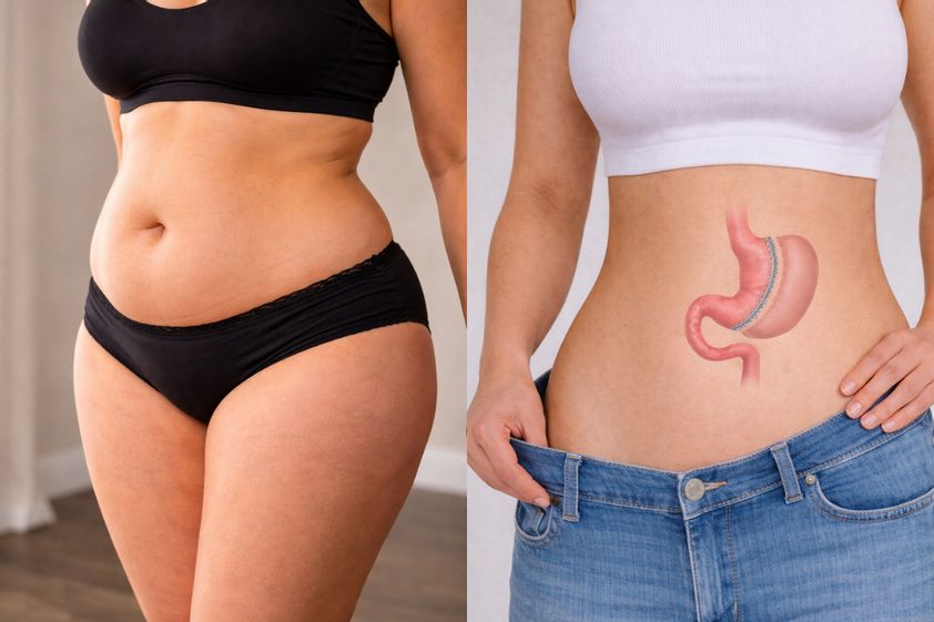 Sleeve gastrectomie