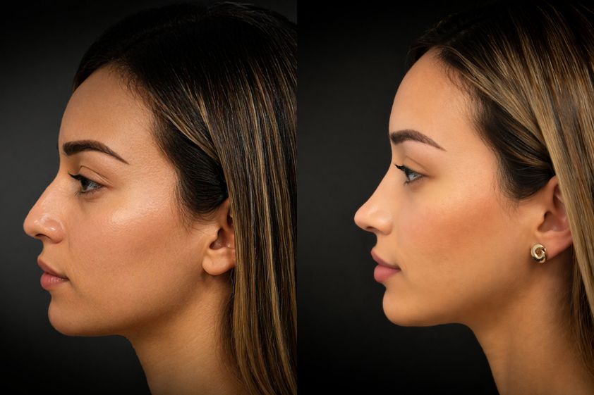 Rhinoplastie secondaire