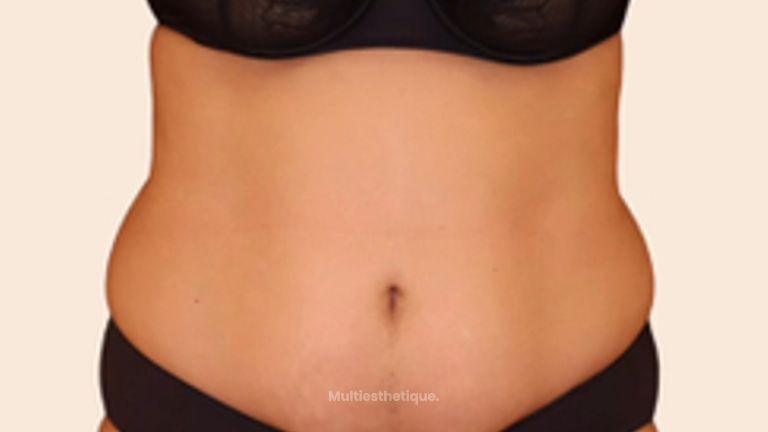 Liposuccion - Dr Maxime Cowen