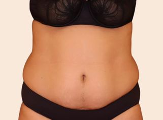 Liposuccion - Dr Maxime Cowen