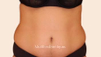 Liposuccion - Dr Maxime Cowen