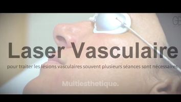 Laser vasculaire