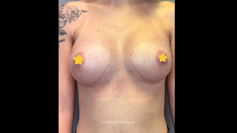 Augmentation mammaire - Dr Behzad Badie Modiri