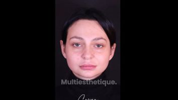 Rhinoplastie - Dr Maxime Cowen