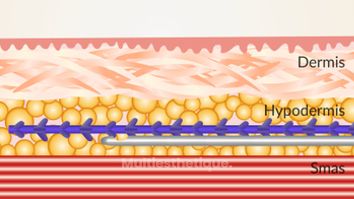 Thread and lift Animation retrait - Dr Molimard Catherine 