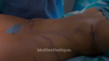 Liposuccion - Dr Maxime Cowen