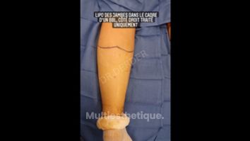 Liposuccion - Dr Mohamed Derder