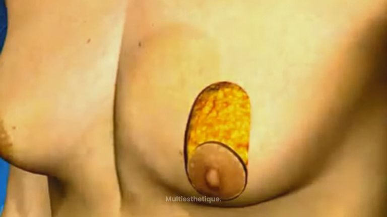 La gynécomastie, réduction des seins chez l'homme