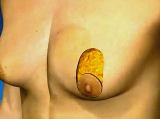 La gynécomastie, réduction des seins chez l'homme