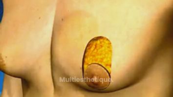 La gynécomastie, réduction des seins chez l'homme