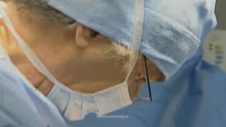 Comment se déroule une liposuccion du ventre ? 