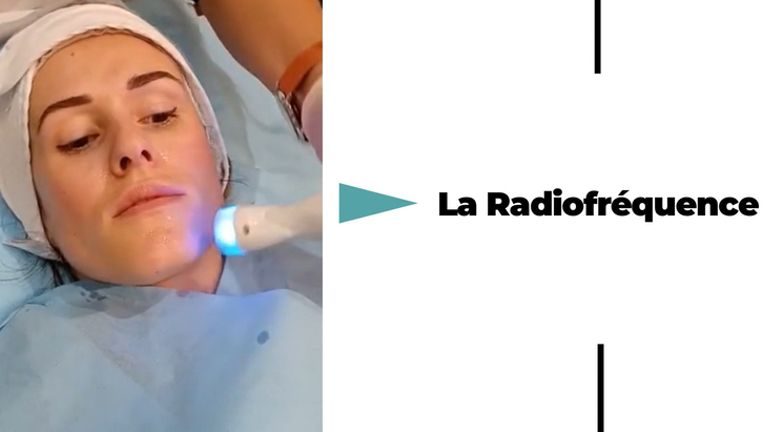 Radiofréquence Visage - Dr Catherine De Goursac