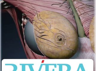 Augmentation mammaire - Dr Juan Carlos Rivera