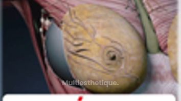 Augmentation mammaire - Dr Juan Carlos Rivera