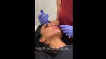 Augmentation des lèvres - Dr Catherine Eychenne - Esthetic Medicare Center