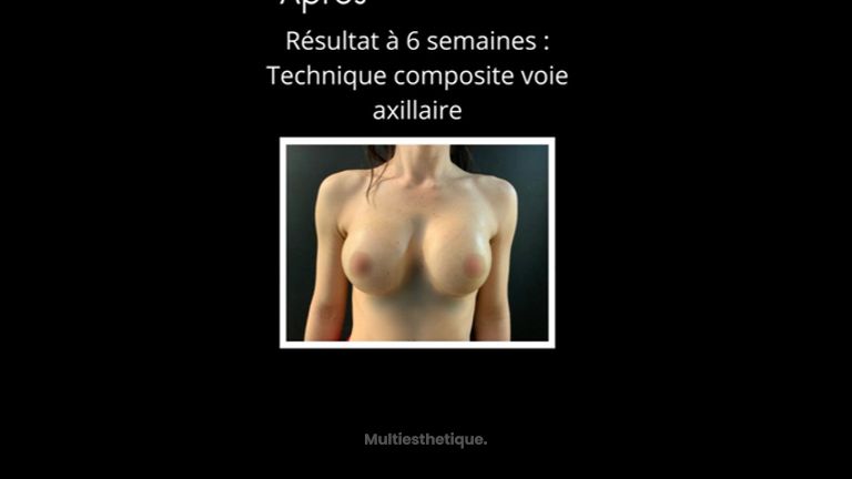 Augmentation mammaire - Dr Paul Seknadje