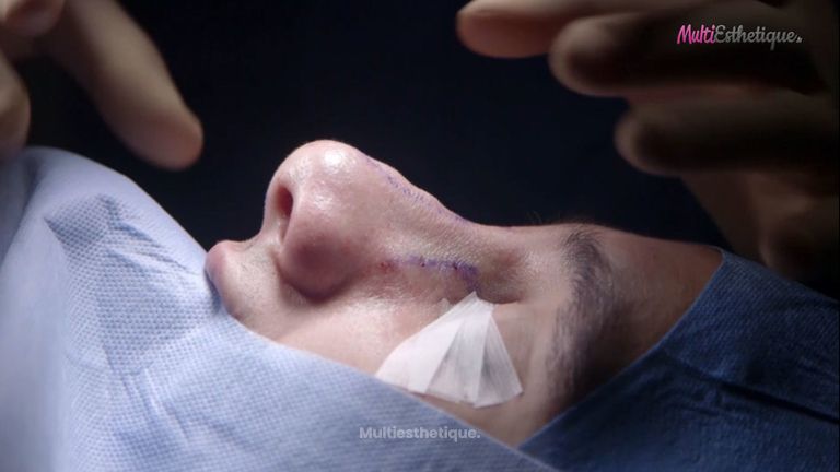 La rhinoplastie