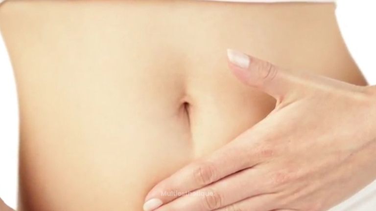 La cryolipolyse n'est pas une technique d'amaigrissement
