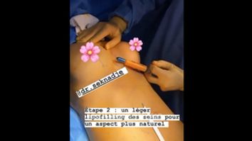 Lipofilling mammaire - Dr Paul Seknadje