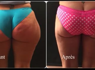 La liposuccion de la culotte de cheval