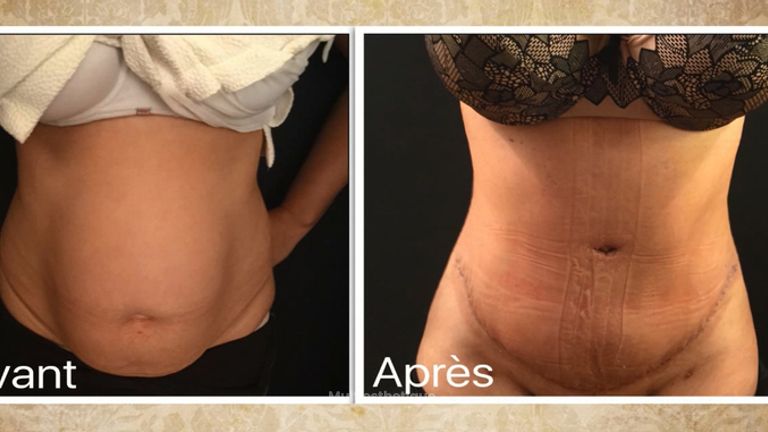 Abdominoplastie après grossesse gémellaire